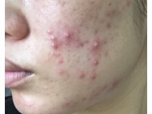 ウィズサロン(withサロン)/ニキビケアハーブピーリング