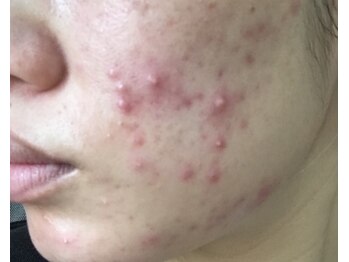 ウィズサロン(withサロン)/ニキビケアハーブピーリング