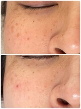 エン(enn)/【シミ・くすみ改善】