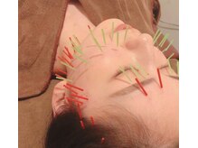 サロン リーナ 北千住店(Salon Lena)/リフトアップ美容鍼