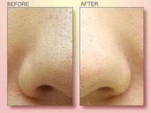 ジュリア オージェ 四条河原町店/ビフォーアフター（鼻スパ）