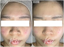 キー(kii)/毛穴+ソフトハーブピーリング