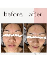 ミルル(milulu)/赤ら顔を改善！