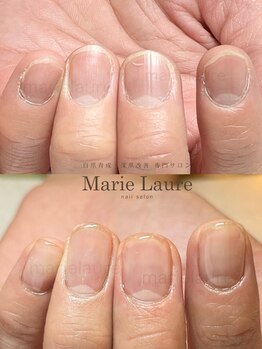 マリーロール 淀屋橋本店(Marie Laure)/自爪育成/深爪矯正/ネイルケア