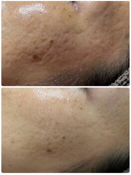 ミーラブ 鹿児島(miilove)/30代 エイジング美肌ケア