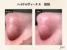 再来☆角栓も角質もごっそり☆ハイドロヴィーナス毛穴洗浄30分￥6000
