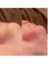 ルナート(Lunart)/毛穴洗浄／毛穴ケア