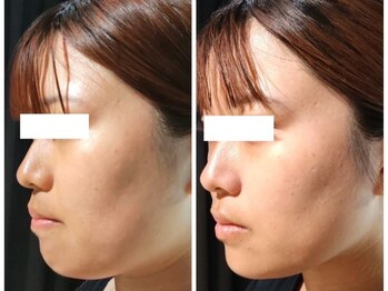 マリアボーテ(MARIA BEAUTE)の写真/今注目の小顔術！見た目年齢が変わる！【韓国で絶大な人気を誇る脂肪分解レモンボトル】ダウンタイムなし◎