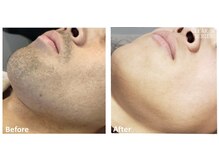 サロンハル(salon haru)/脱ヒゲ剃り！