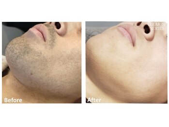 サロンハル(salon haru)/脱ヒゲ剃り!