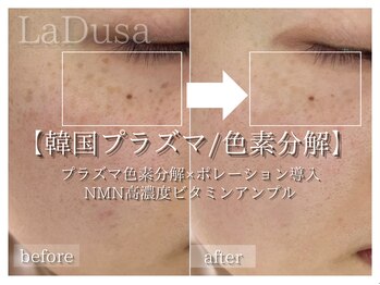 ラ ドゥーサ(La Dusa)/気になるシミケアに韓国プラズマ