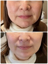 白の雫/シミケア施術前後(当日変化)