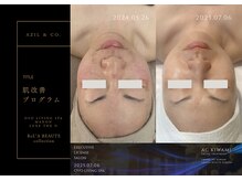 オーヴォ リビングスパ アネックス マノン(OVO LIVING SPA annex MANON)/【施術事例】肌改善プログラム