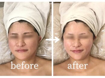 ボーレーヴ(beau reve)/小顔/リフトアップ/フェイシャル