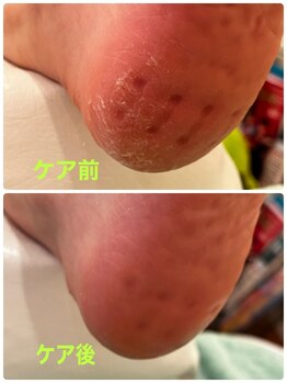 ネイルサロンアンドスクール シーグリーン(SEAGREEN)/夏までにかかとのガサガサをケア