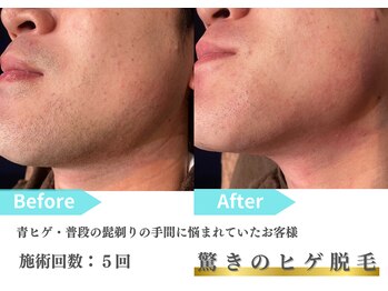 トレース/ヒゲ脱毛の効果