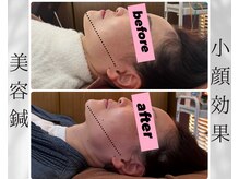 エクラ(Eclat)の雰囲気（大人気！様々なお悩みに合わせたオーダーメイドの美容鍼です♪）