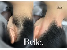 ベル(Belle)/【症例】うなじ脱毛