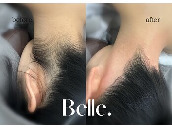 ベル(Belle)/【症例】うなじ脱毛