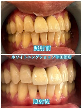 ホワイトニングショップ 津田沼店/before&after美白ホワイトニング