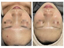 レミリー(Lemiry)/ハーブピーリング