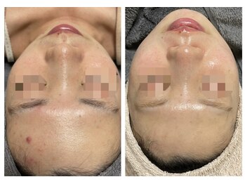 レミリー(Lemiry)/ハーブピーリング