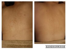 ベビースキン(baby skin)/背中のブツブツ改善