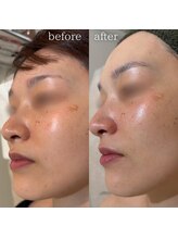 エステティックサロン ナチュラーレ/シミ・くすみ・ツヤ感アップ