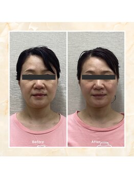 プレメ 人形町院(The Preme)/美容鍼 2回施術後