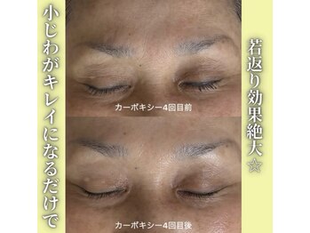 ハニエル(Haniel)/カーボキシー症例