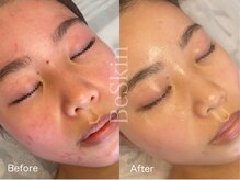 ビースキン 藤沢店(BeSkin)/もう隠さない、最短赤みケア