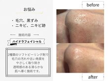シロ(CHILO)/ハイドラbefore・after