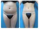 庭夢エステの写真/【夏太りをリセット!脂肪を徹底燃焼】ぽっこりお腹、むくみ足、むっちり二の腕背中をスッキリ◇安城/痩身
