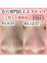 エフドット(f.)/《毛穴美人コース》