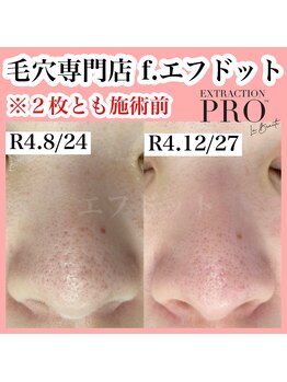 エフドット(f.)/《毛穴美人コース》