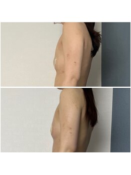 モア(moa)/デコルテのそげ 解消