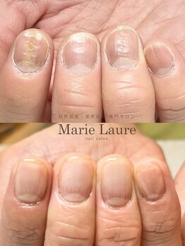 マリーロール 淀屋橋本店(Marie Laure)/自爪育成/深爪矯正/ネイルケア