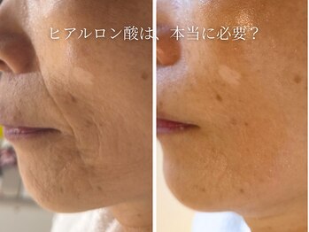 ハナコ 下通店(HANAKO)/【しわ改善、ハリ、弾力回復】