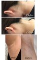 トレース(tres) レディース&メンズ脱毛お任せください！