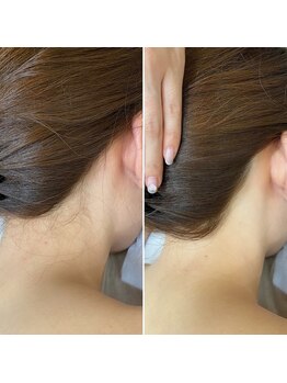 インベスト(INVEST)/うなじ脱毛