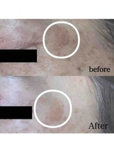 ブランシェ 富山店 × 椿/シミケア　お客様