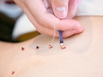 サロン ド ハリッシュ(Salon de HARISH)/お悩みに合わせてお灸も行います