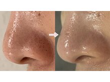 ラシュシュ(La chou chou)/毛穴洗浄/詰まり毛穴/ニキビケア