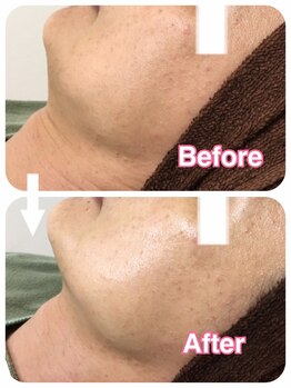 フェイシャルエステ エムズルーム(M's room)/気になる首のたるみ・しわケア