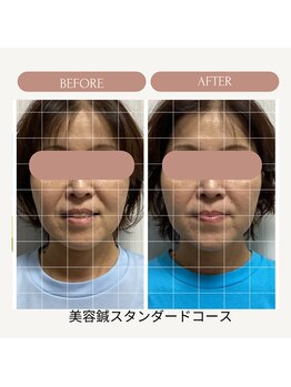 サロン ド ハリッシュ(Salon de HARISH)/ほうれい線にも効果◎