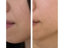 アドビューティ(Add Beauty)/≪たるみ改善／RFリフティング≫