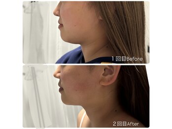 ラグ(LUXU)/レモンボトル、モニター様♪