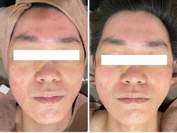 ホワイトアクア 四日市店(WHITE AQUA)/メンズエステ四日市/ハーブREVI