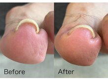 ロンディネ(Rondine)/巻き爪ケア/ネイルトリム/2511