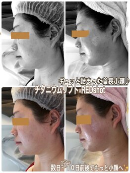 アルページュ(Arpege)/スッキリ革命チタニウムREDSHOT